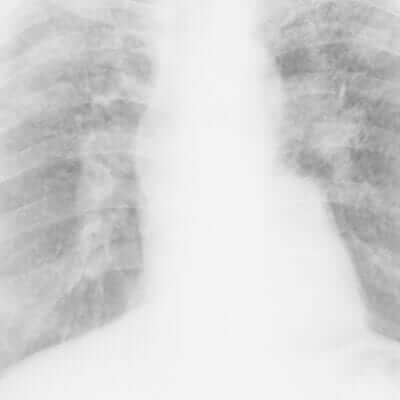 X-ray of miner's lungs