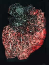 The black lung patient in the x-ray above had the lung pictured above removed during a transplant operation.